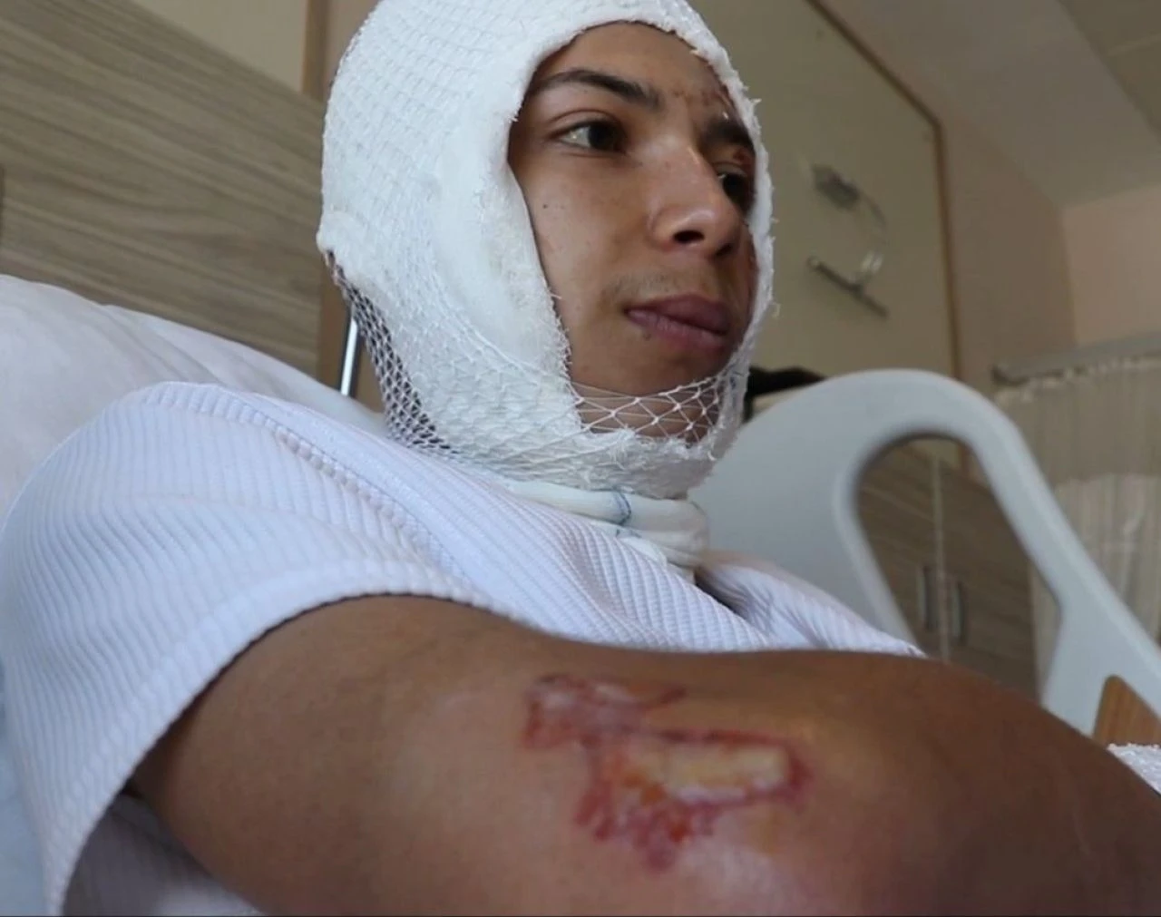 Elektronik sigara patladı, dehşeti yaşadı! Yüzü ve vücudu yandı - 2. Resim