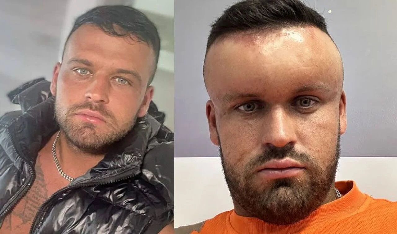 Saç boyası yüzünden korkunç bir hale geldi: Yüzü şişti, gözü kapandı, nefes alamadı