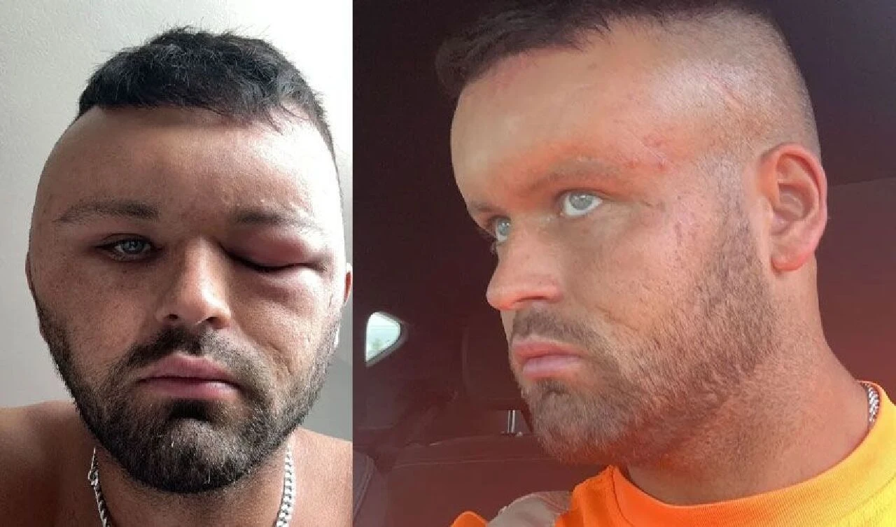 Saç boyası yüzünden korkunç bir hale geldi: Yüzü şişti, gözü kapandı, nefes alamadı