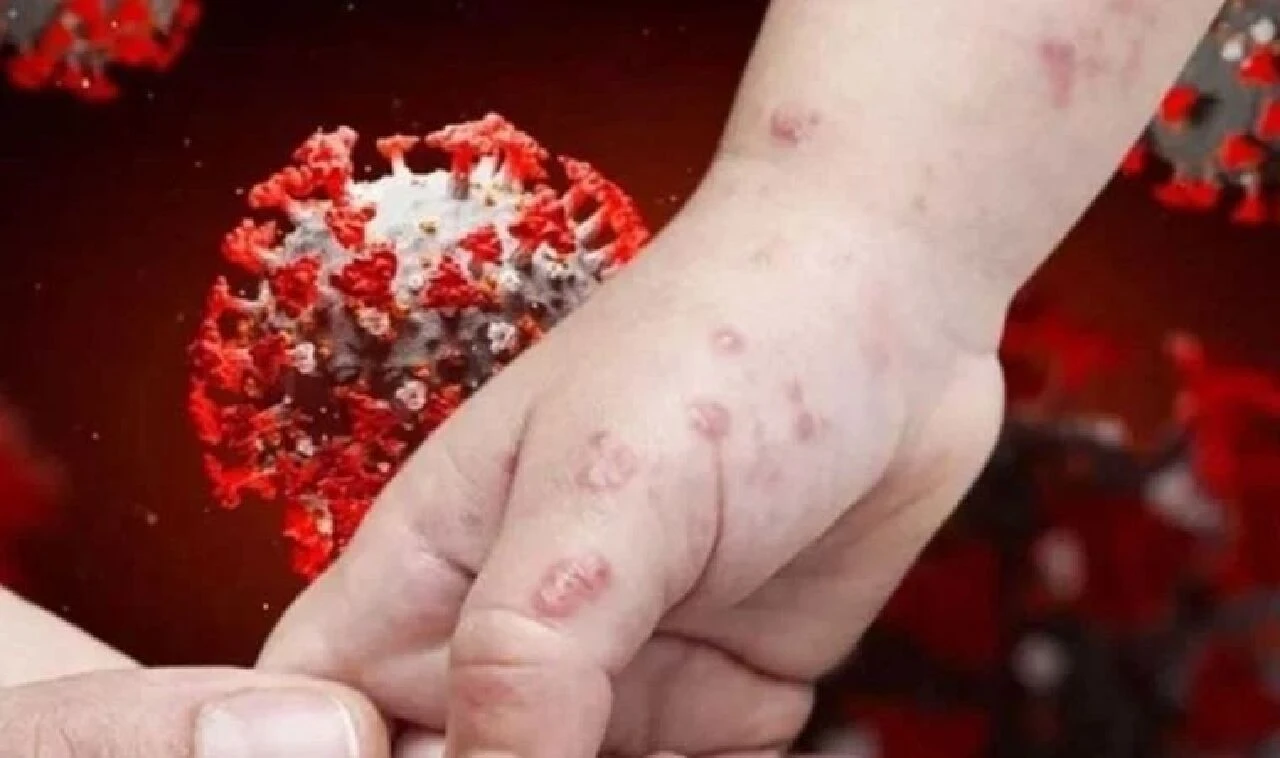 Dünya Sağlık Örgütü acil durum ilan etmeye hazırlanıyor! Ölümcül mpox sınırları aşıyor - 3. Resim
