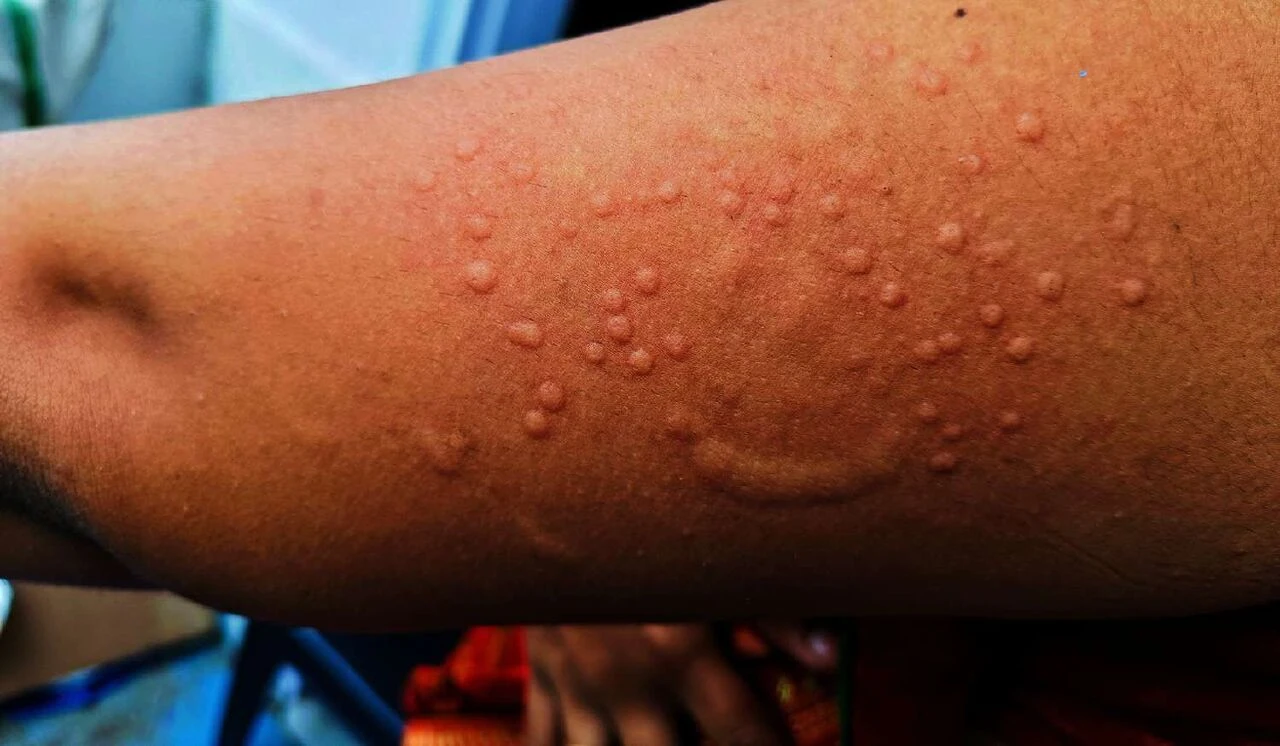 Dünya Sağlık Örgütü acil durum ilan etmeye hazırlanıyor! Ölümcül mpox sınırları aşıyor - 2. Resim