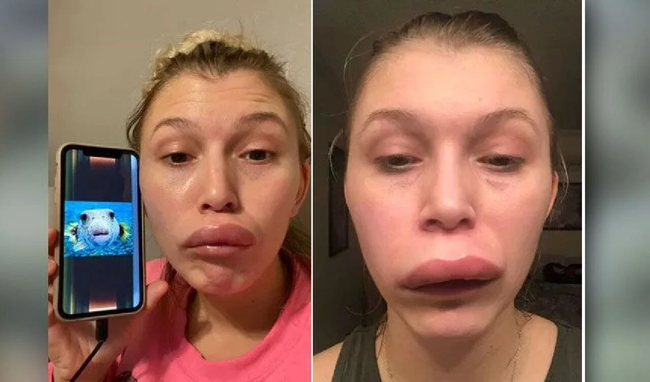 Kendisini balon balığı gibi şişiren hastalık 11 yıl sonra fark edildi! Ölümcül riski de var - 2. Resim