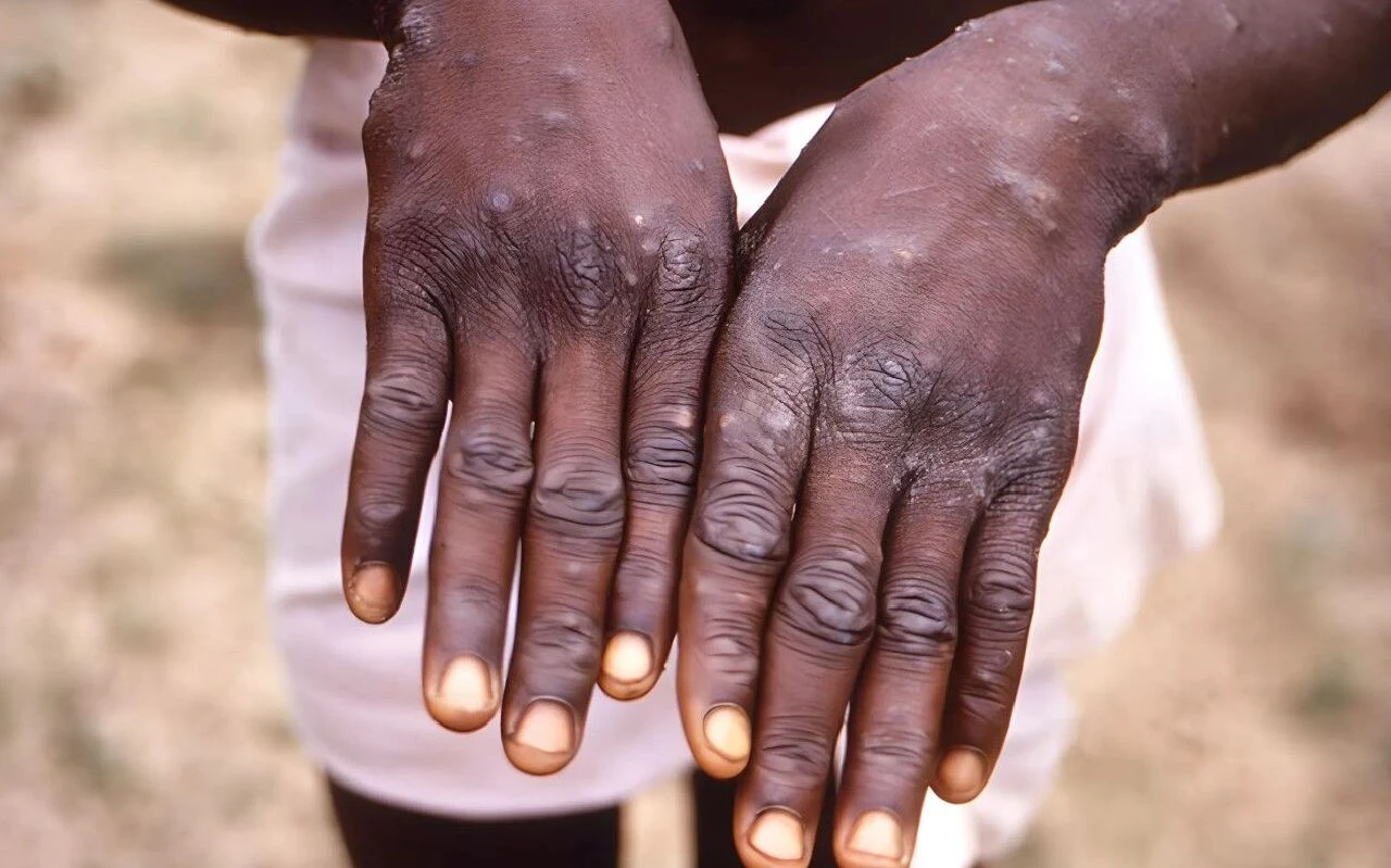 Son dakika | DSÖ'den korkulan haber geldi: M çiçeği virüsü acil durum oluşturuyor! - 1. Resim