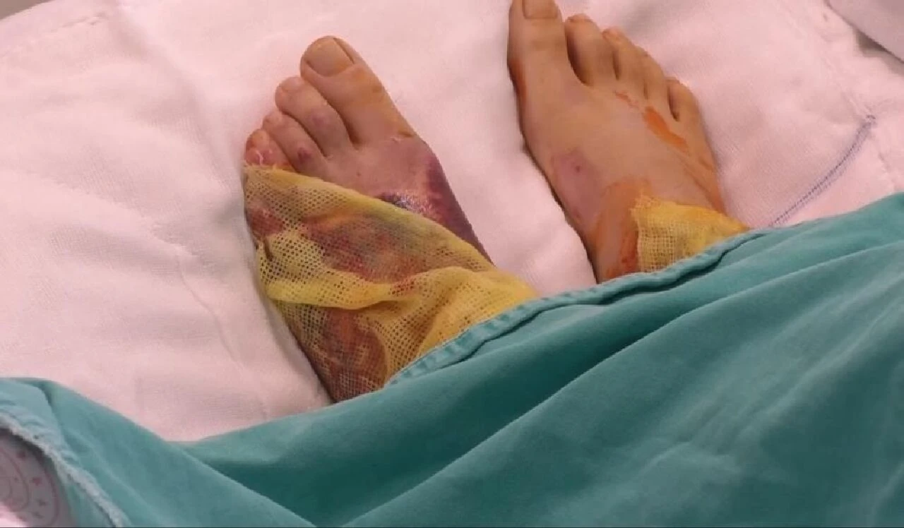 Mangalcılar dikkat! Sakın bunu yapmayın: Harlamak istedi ölümden döndüler - 3. Resim