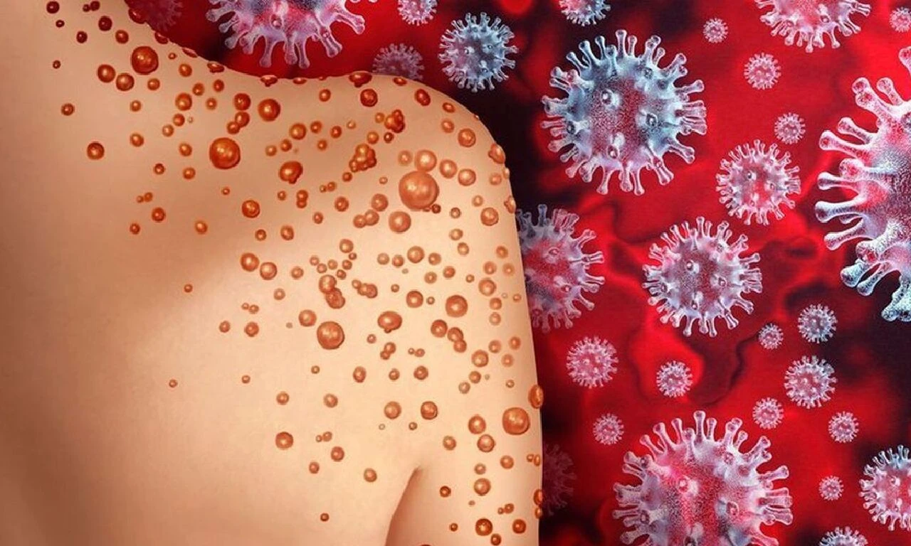 Maymun çiçeği virüsü harekete geçirdi! Herkes tetikteydi, yetkililer acil önlem paketini açıkladı