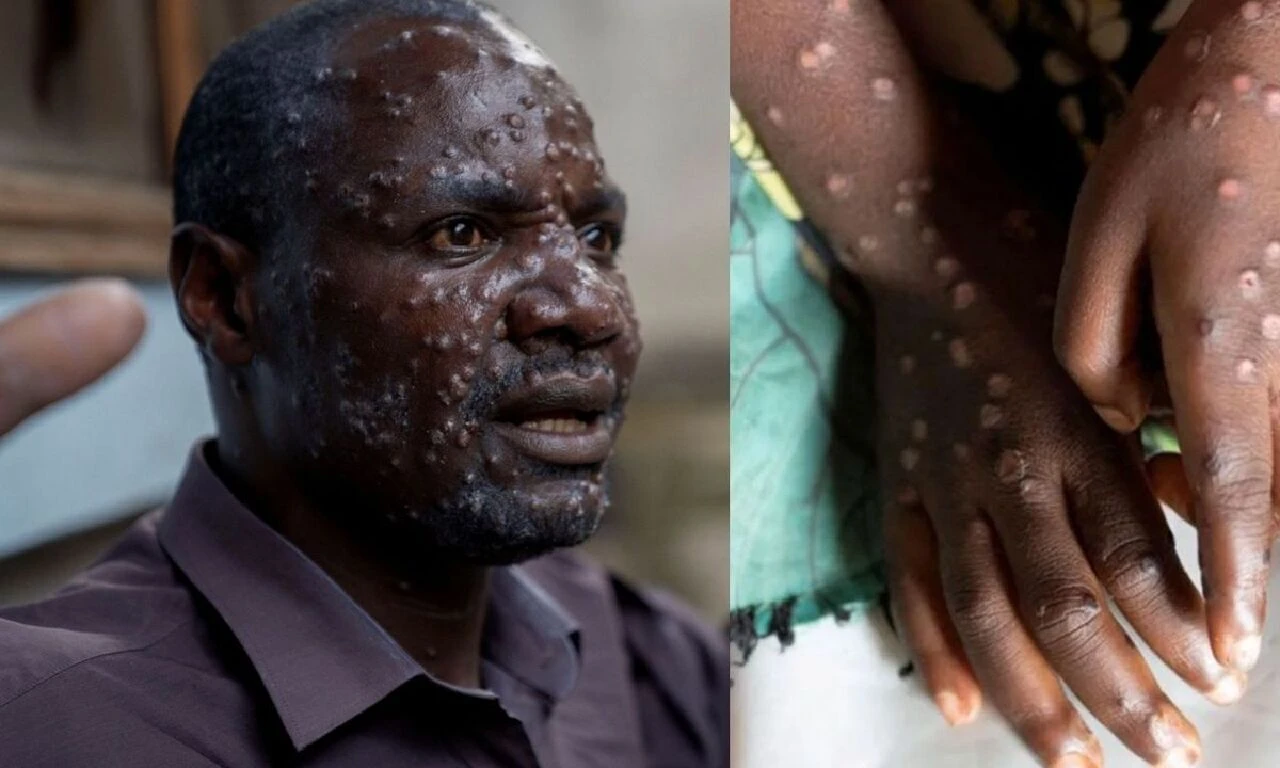 Maymun çiçeği virüsü harekete geçirdi! Herkes tetikteydi, yetkililer acil önlem paketini açıkladı