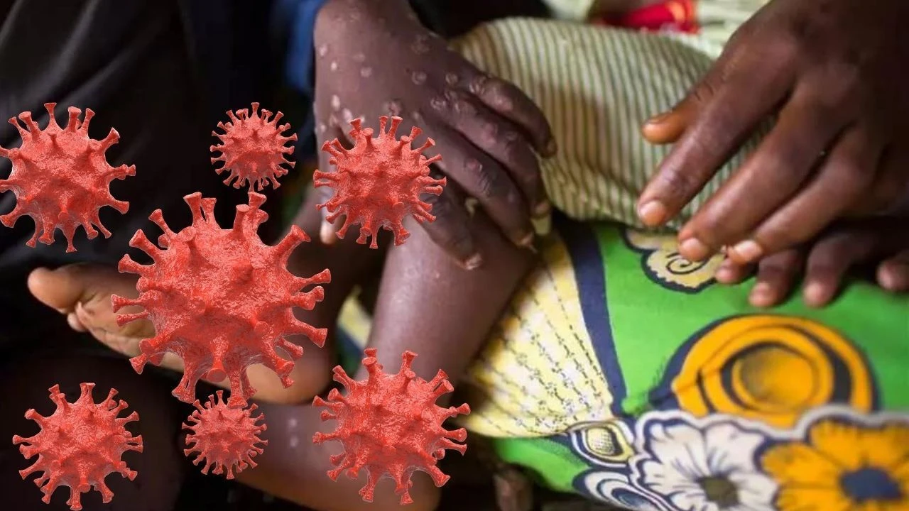 Maymun çiçeği virüsünde ölüm vakaları nadir görülüyor! Ölümcüllük riski için DSÖ’den yeni bir uyarı yok