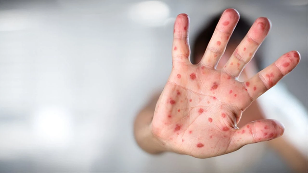 Maymun çiçeği virüsünde ölüm vakaları nadir görülüyor! Ölümcüllük riski için DSÖ’den yeni bir uyarı yok