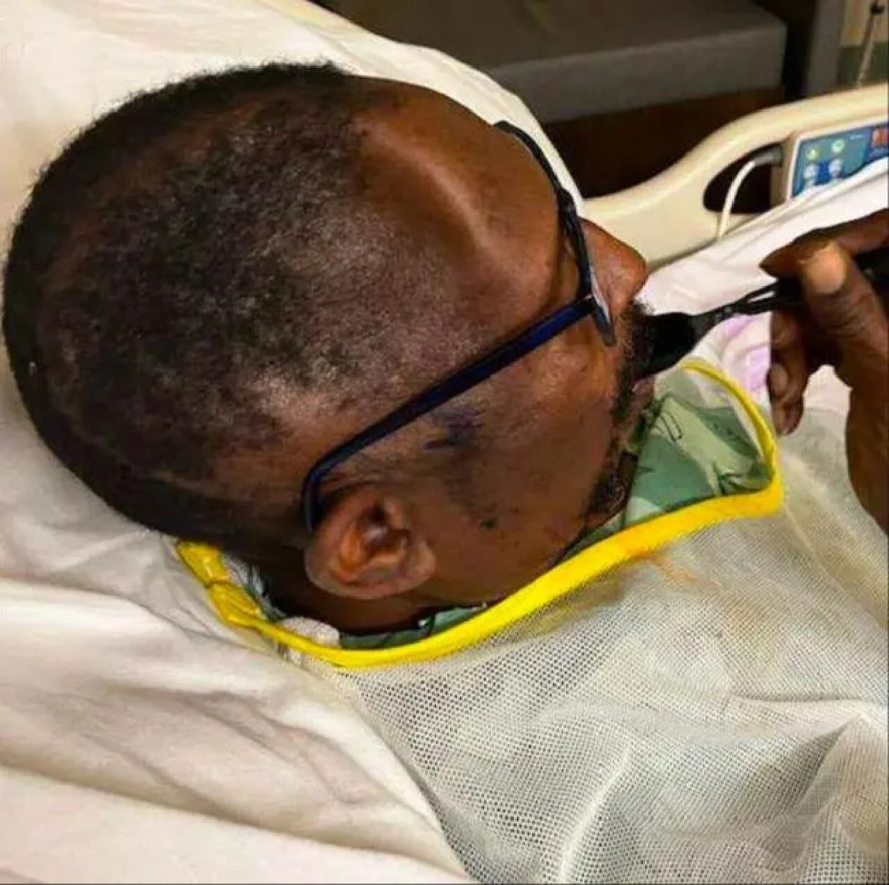 Vücudunun bir parçasını kaybeden hastane skandallara imza attı! ABD'de bir garip olay - 2. Resim