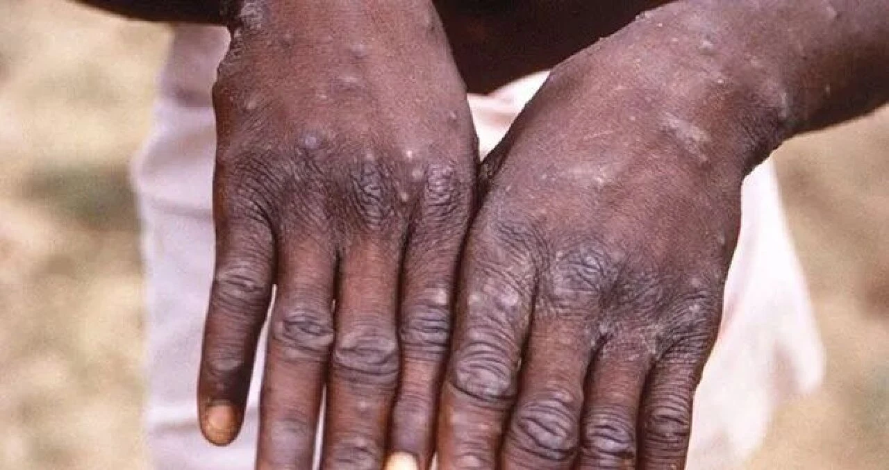 En az 570 M çiçeği virüsü ölümü ve binlerce vaka var! Kongo'da maymun çiçeği yayılıyor