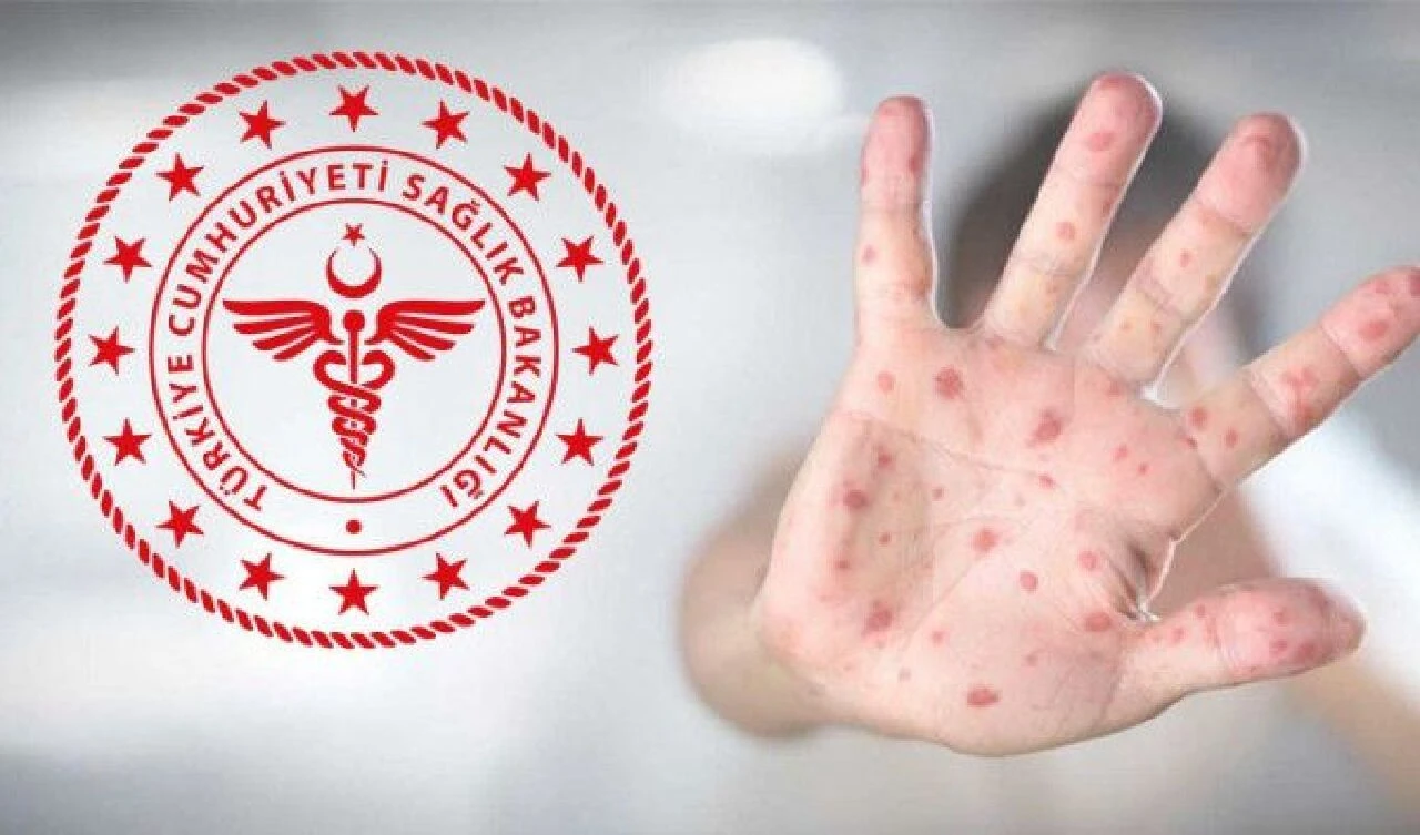 En az 570 M çiçeği virüsü ölümü ve binlerce vaka var! Kongo'da maymun çiçeği yayılıyor