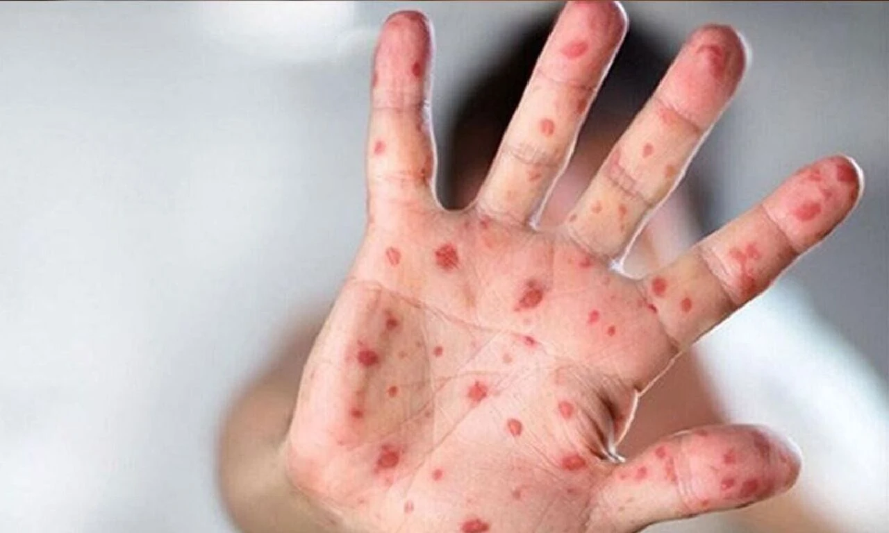 Maymun çiçeği virüsü ile ilgili merak edilenler! Sağlık Bakanlığı 11 soruda cevapladı