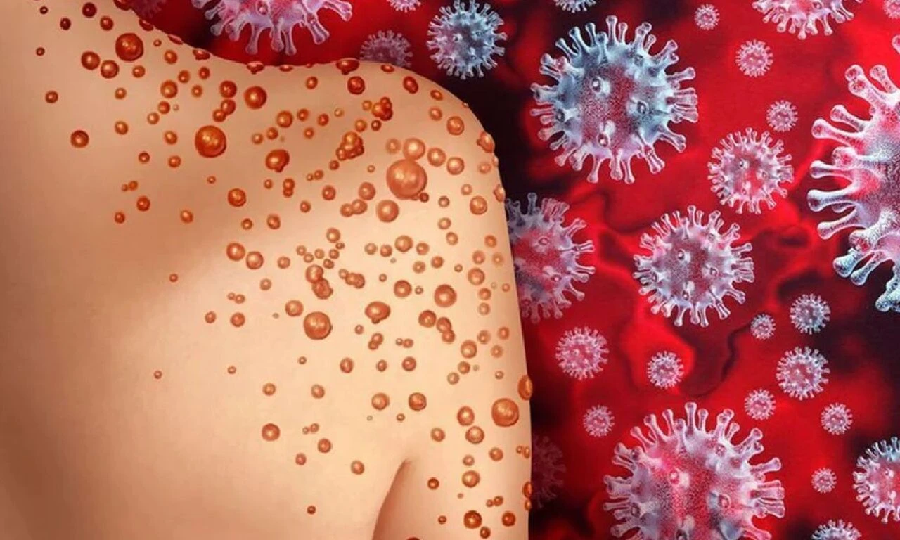 Maymun çiçeği virüsü ile ilgili merak edilenler! Sağlık Bakanlığı 11 soruda cevapladı