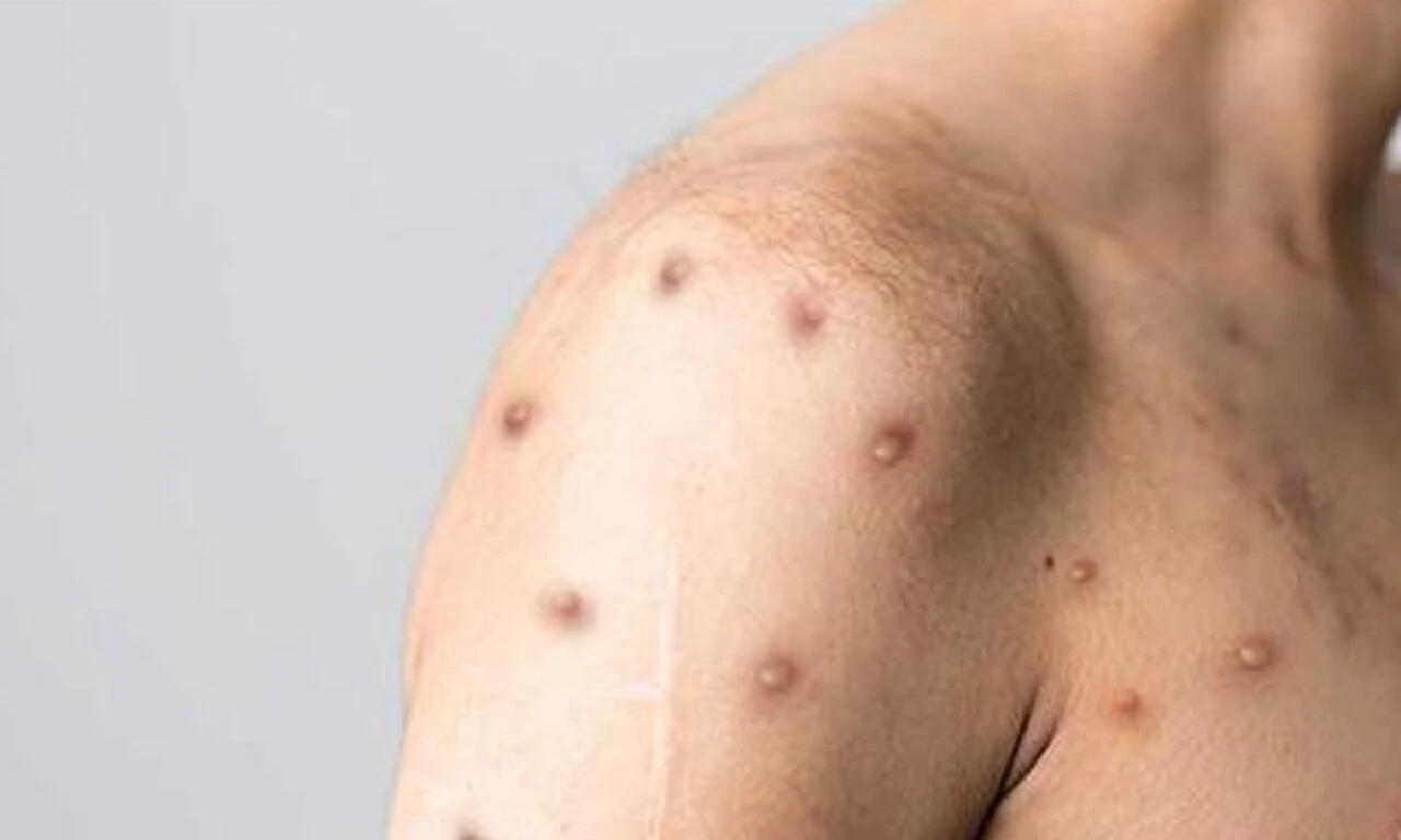 Maymun çiçeği virüsü ile ilgili merak edilenler! Sağlık Bakanlığı 11 soruda cevapladı