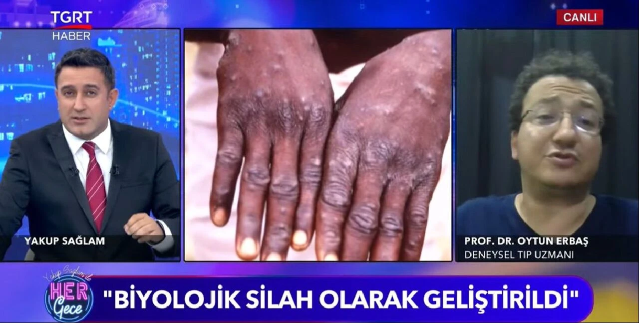 Oytun Erbaş "Koronavirüs Türkleri etkilemez" demişti, maymun çiçeği için uyardı: Türkiye'de görülecek, aşılanacağız