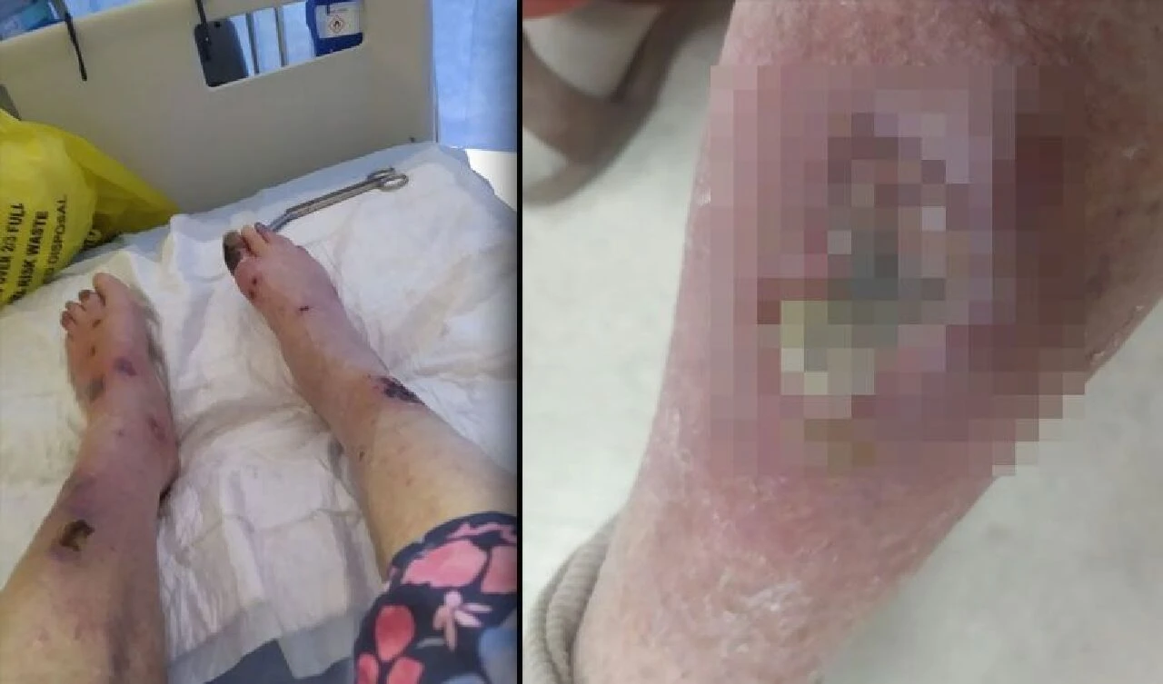 Böcek ısırığı hayatını mahvetti: İki bacağı da kesildi - 2. Resim