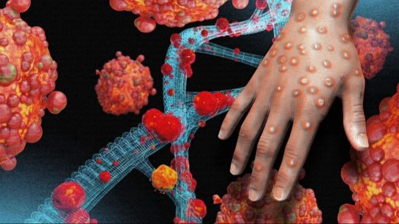 Maymun çiçeği Asya'ya sıçradı! Tayvan'da 403 kişide virüs çıktı - 1. Resim