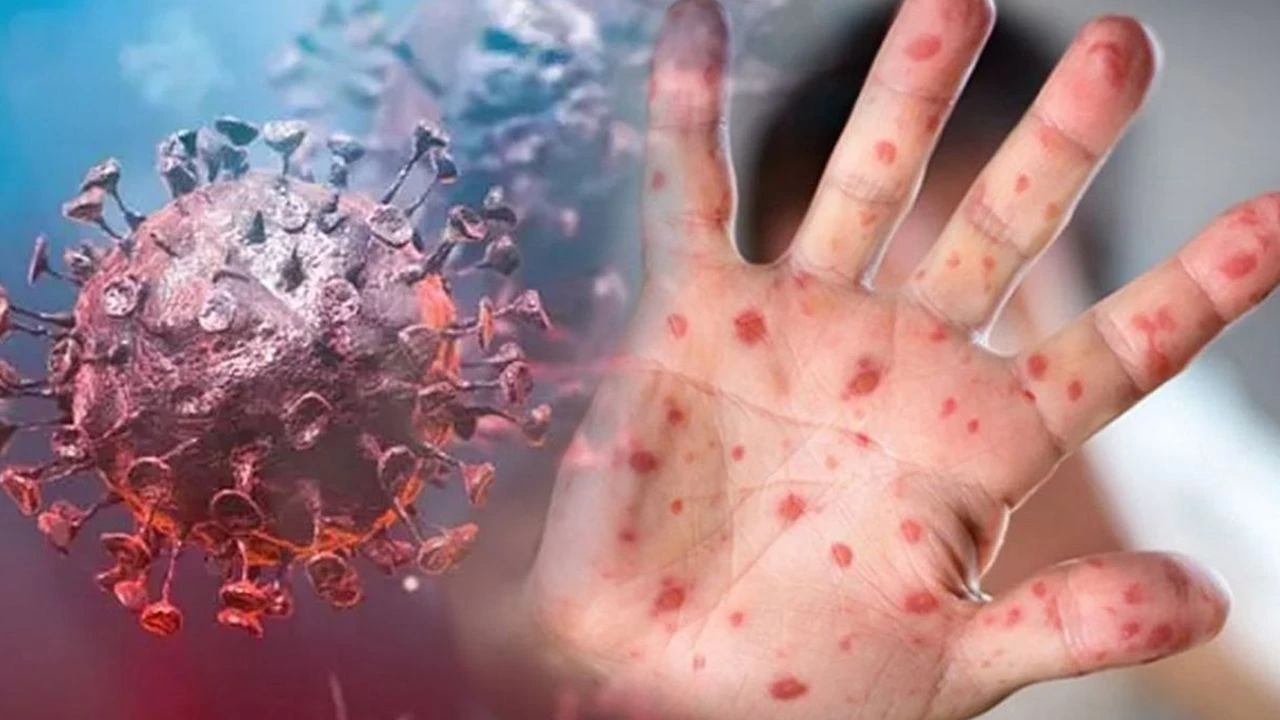 Maymun çiçeği alarmı! O ülkede vaka sayısı giderek artıyor