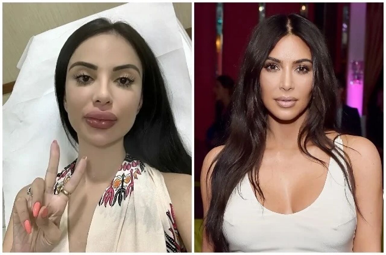 Kim Kardashian'a benzemek için 1 milyon dolar harcadı! Artık anne olamayacak - 3. Resim