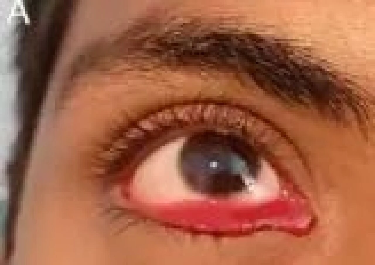 Kanlı gözyaşı vakası doktorları bile şoke etti! Gizemli hastalık ilk de değil