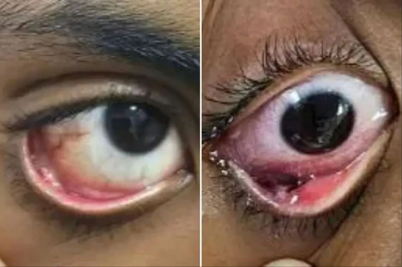 Kanlı gözyaşı vakası doktorları bile şoke etti! Gizemli hastalık ilk de değil