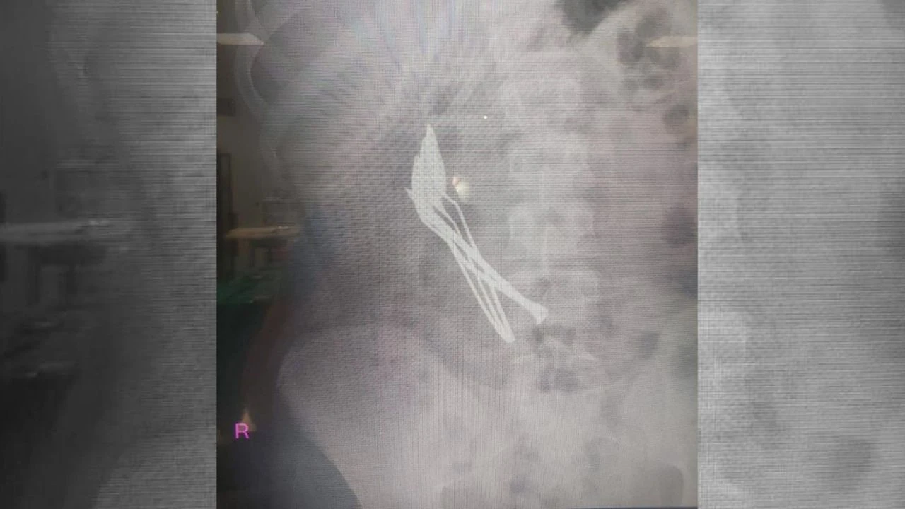 Kayseri'de çocuğun midesinden çıkan kaşıklar doktorları şaşkına çevirdi! - 1. Resim