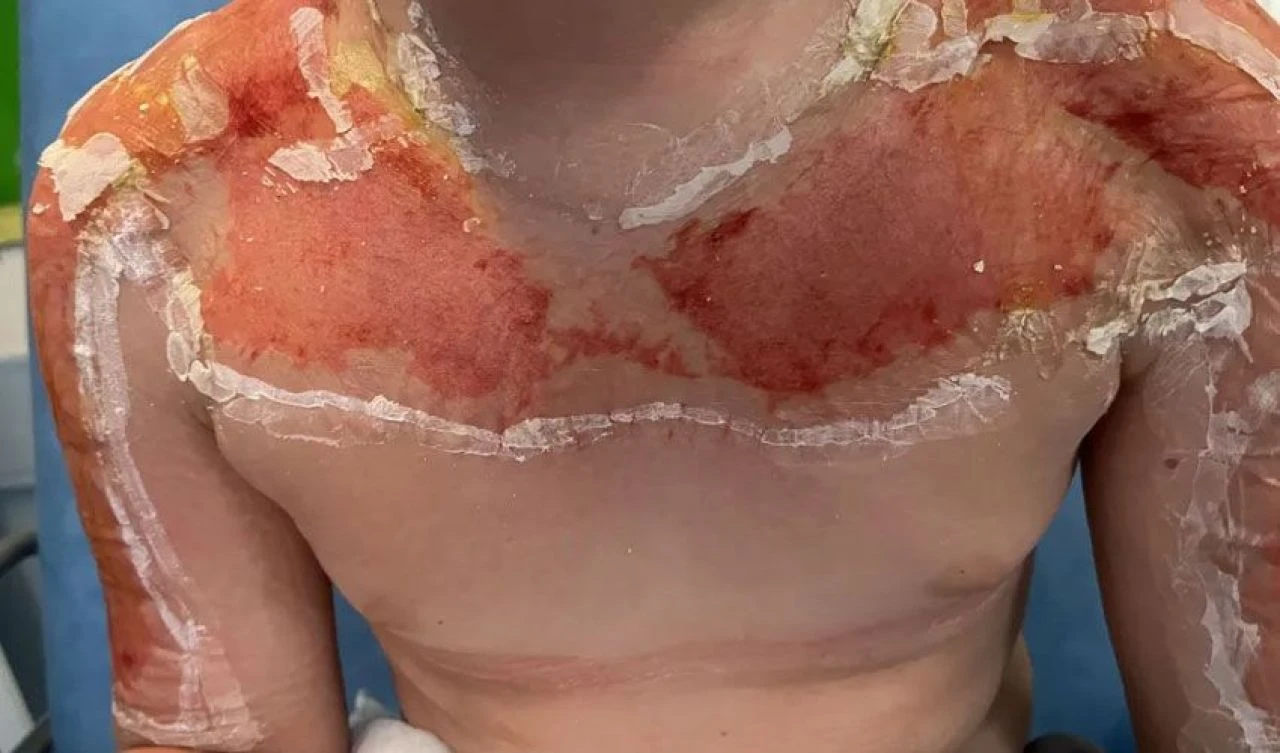 Sadece 2 saat içinde vücudu kabarcıklarla doldu! Anne çocuğunun başına gelenleri anlatıp, uyardı - 2. Resim