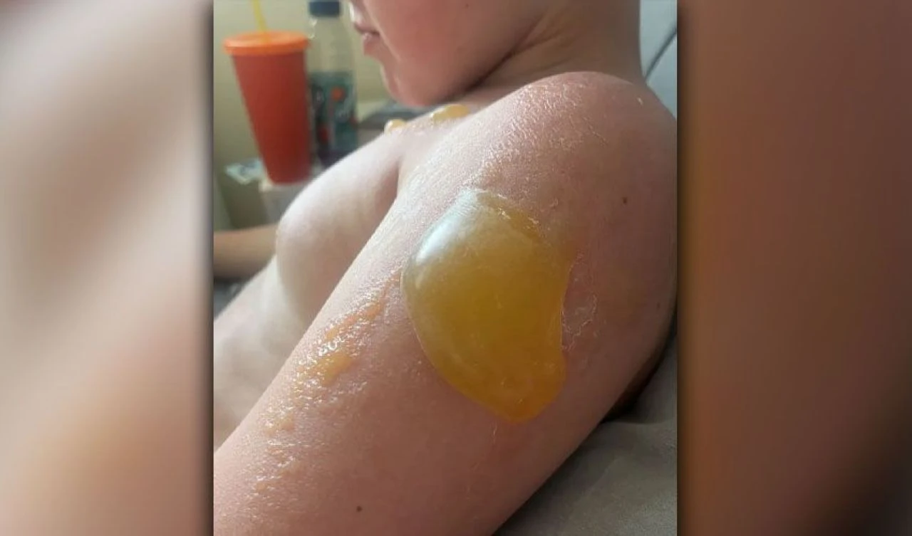Sadece 2 saat içinde vücudu kabarcıklarla doldu! Anne çocuğunun başına gelenleri anlatıp, uyardı - 1. Resim