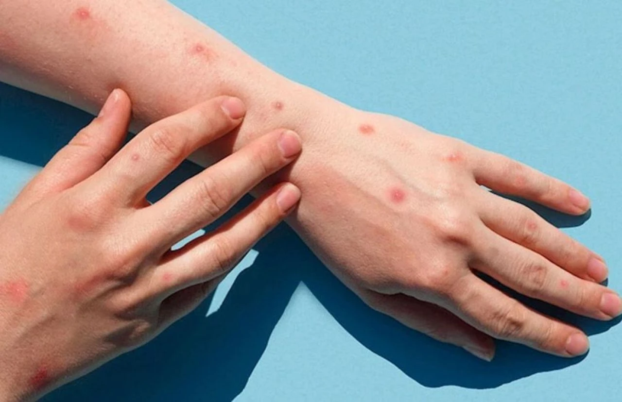 Maymun çiçeği virüsü ile ilgili sıcak gelişme! DSÖ ilk aşıya onay verdi