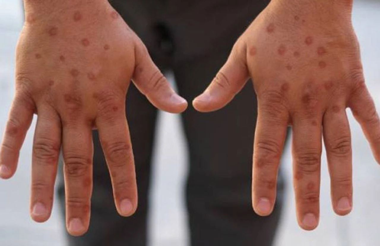 Maymun çiçeği virüsü ile ilgili sıcak gelişme! DSÖ ilk aşıya onay verdi