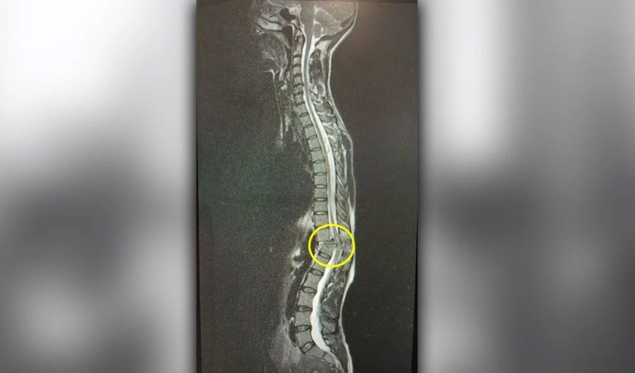 Spor salonunda yaptığı hata felç bıraktı: Sırtımın kırıldığını duydum - 3. Resim
