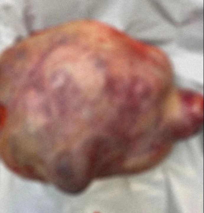 Göğsünden boynuna kadar uzandı, tam 7 kilo! Doktorlar tek seansta tümörü temizledi - 2. Resim