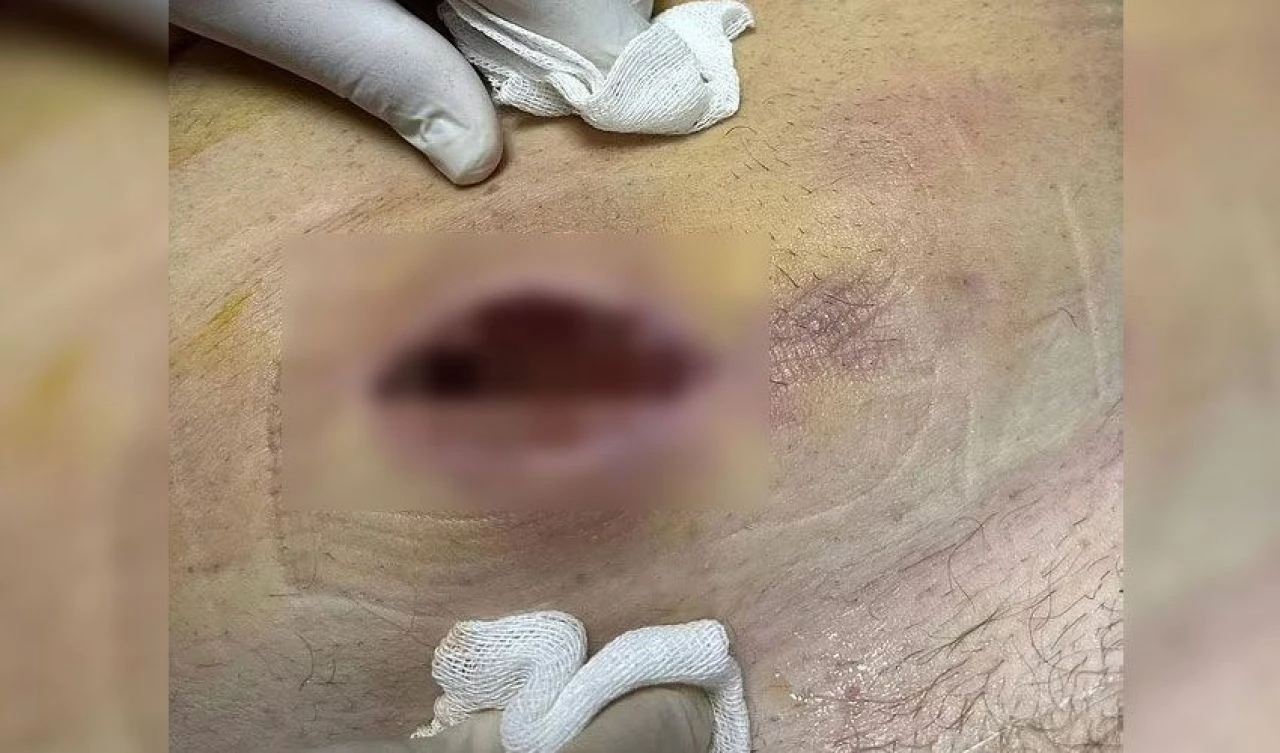 Örümcek ısırığını umursamadı vücudunda kocaman bir delik açıldı! Az kalsın ölüyordu