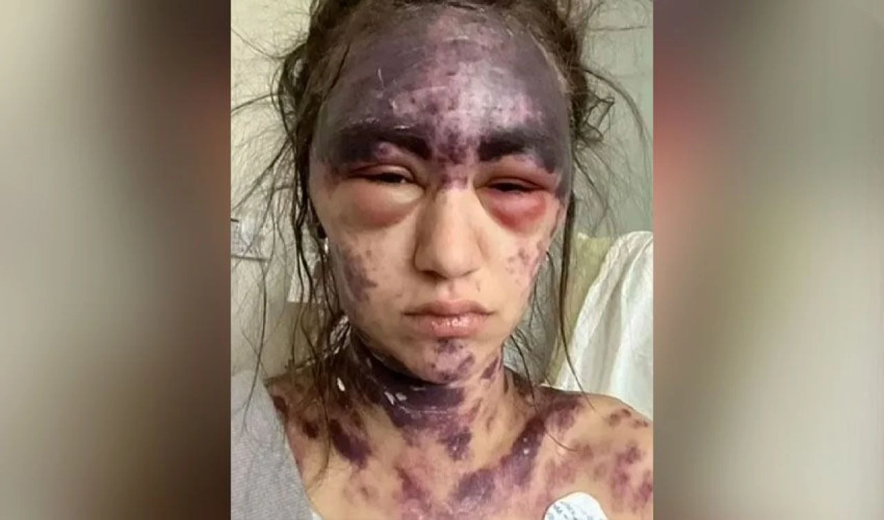 Nadir görülen hastalık yüzünden genç kız acı verici morluklarla geçici olarak kör kaldı!