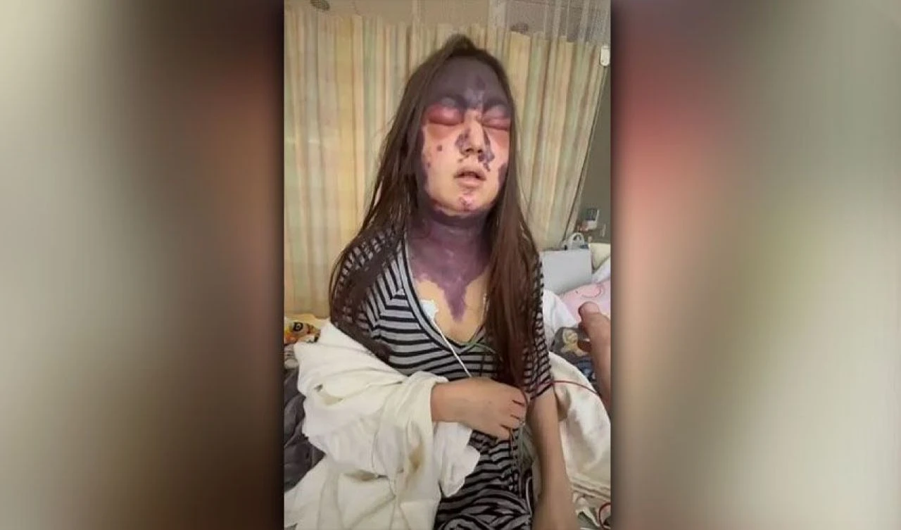 Nadir görülen hastalık yüzünden genç kız acı verici morluklarla geçici olarak kör kaldı!