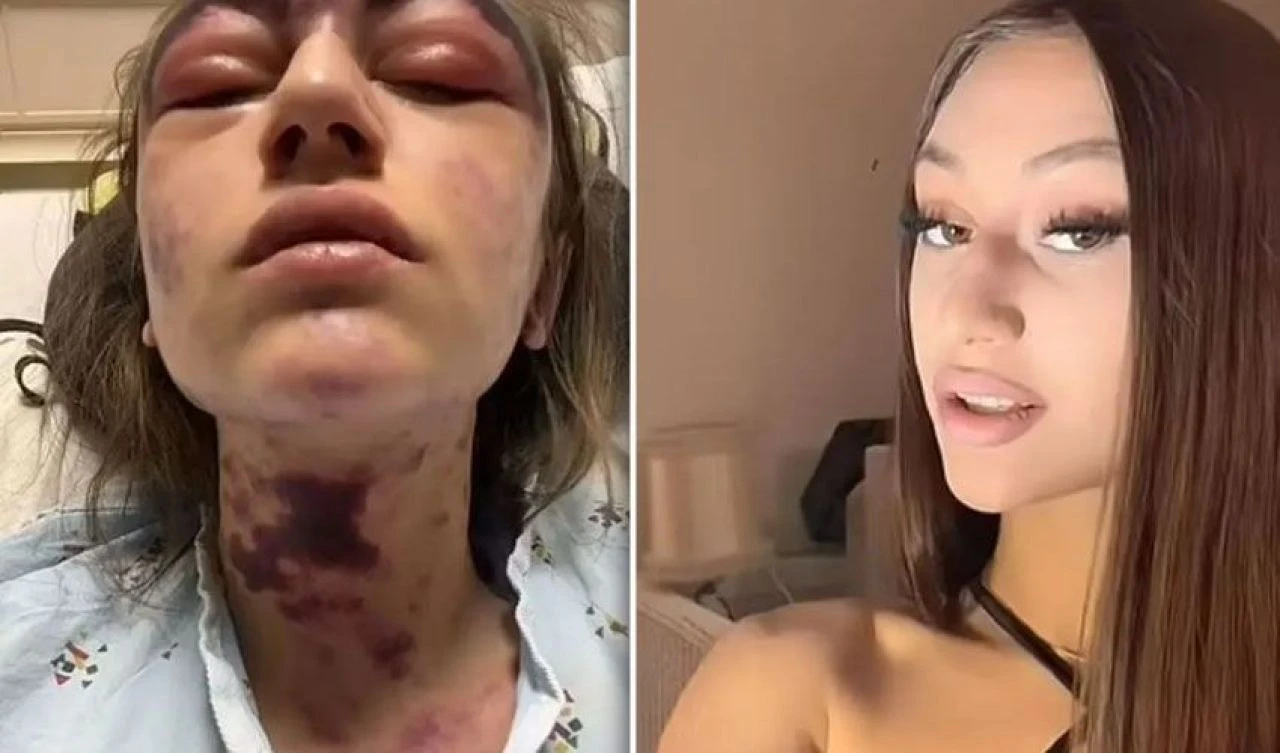 Nadir görülen hastalık yüzünden genç kız acı verici morluklarla geçici olarak kör kaldı!