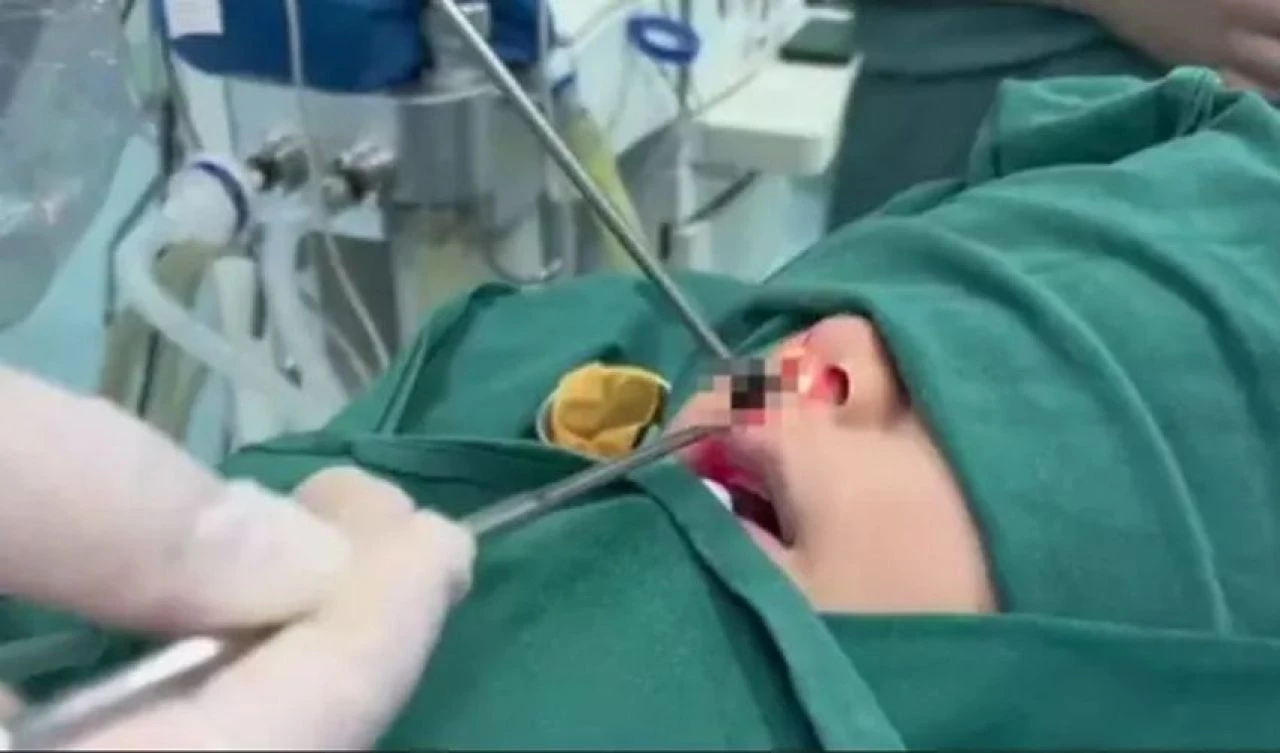 Burnundan kötü kokular gelen çocuk acil ameliyata alındı! Doktorun burun boşluğunda bulduğu şey herkesi şoke etti