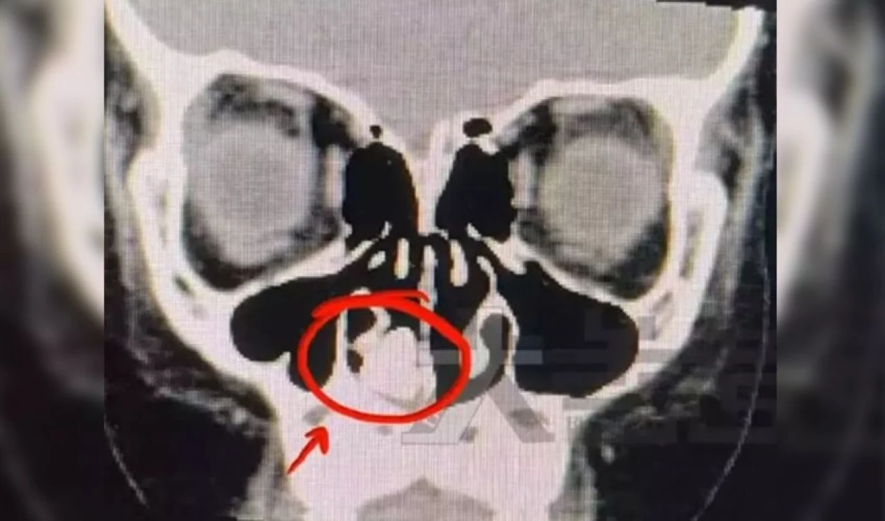 Burnundan kötü kokular gelen çocuk acil ameliyata alındı! Doktorun burun boşluğunda bulduğu şey herkesi şoke etti
