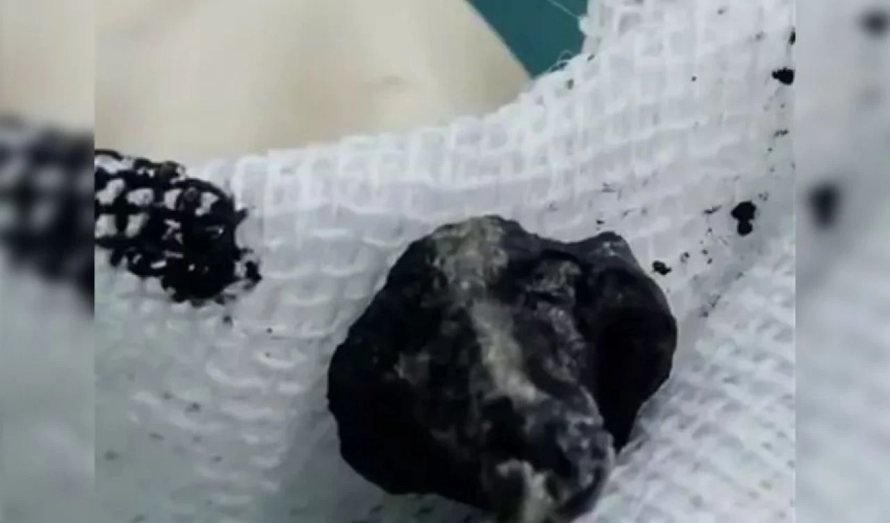 Burnundan kötü kokular gelen çocuk acil ameliyata alındı! Doktorun burun boşluğunda bulduğu şey herkesi şoke etti