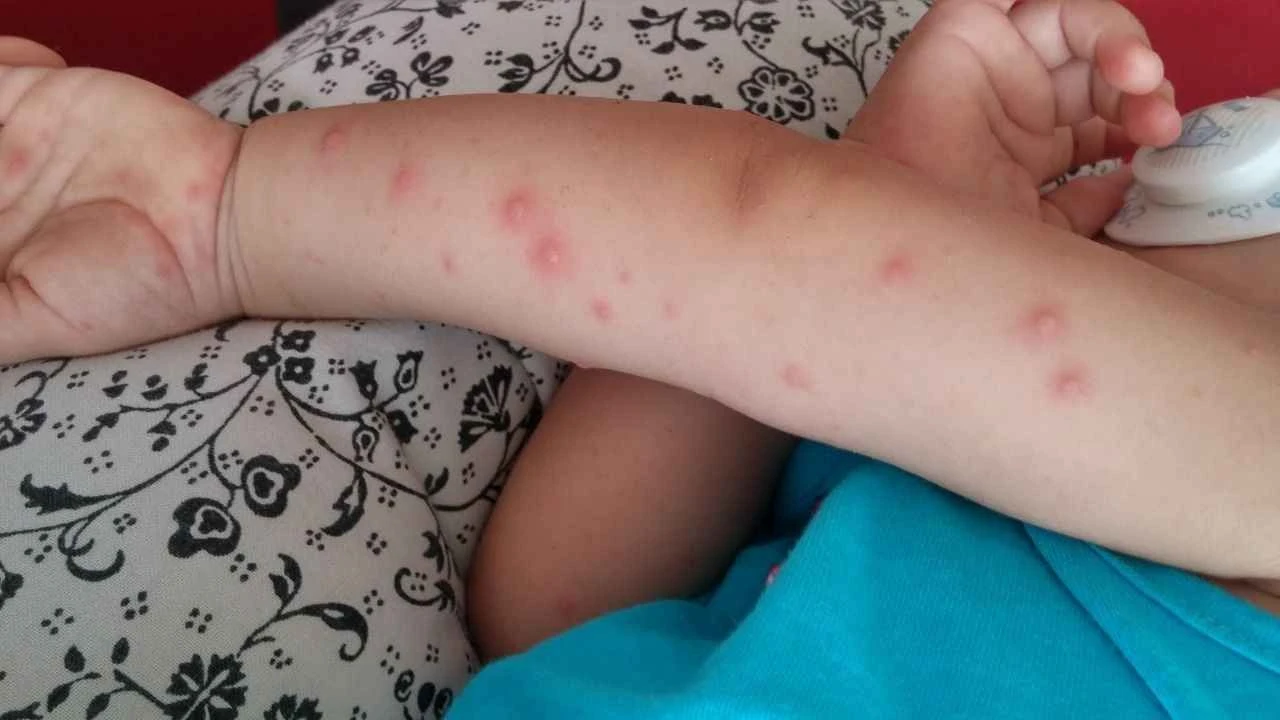 Bir şehrimizde 11 öğrencide birden görüldü! 2-10 yaş arası çocuğu olanlar dikkat, şimdi tam mevsimi - 1. Resim