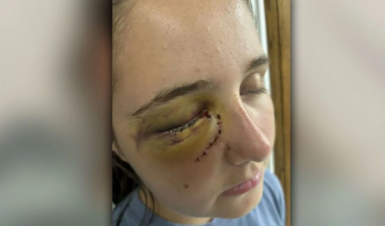 Genç kızın gözü 'duvara fırlatılmış üzüm gibi' patladı! Başına gelenleri bir bir anlattı - 2. Resim