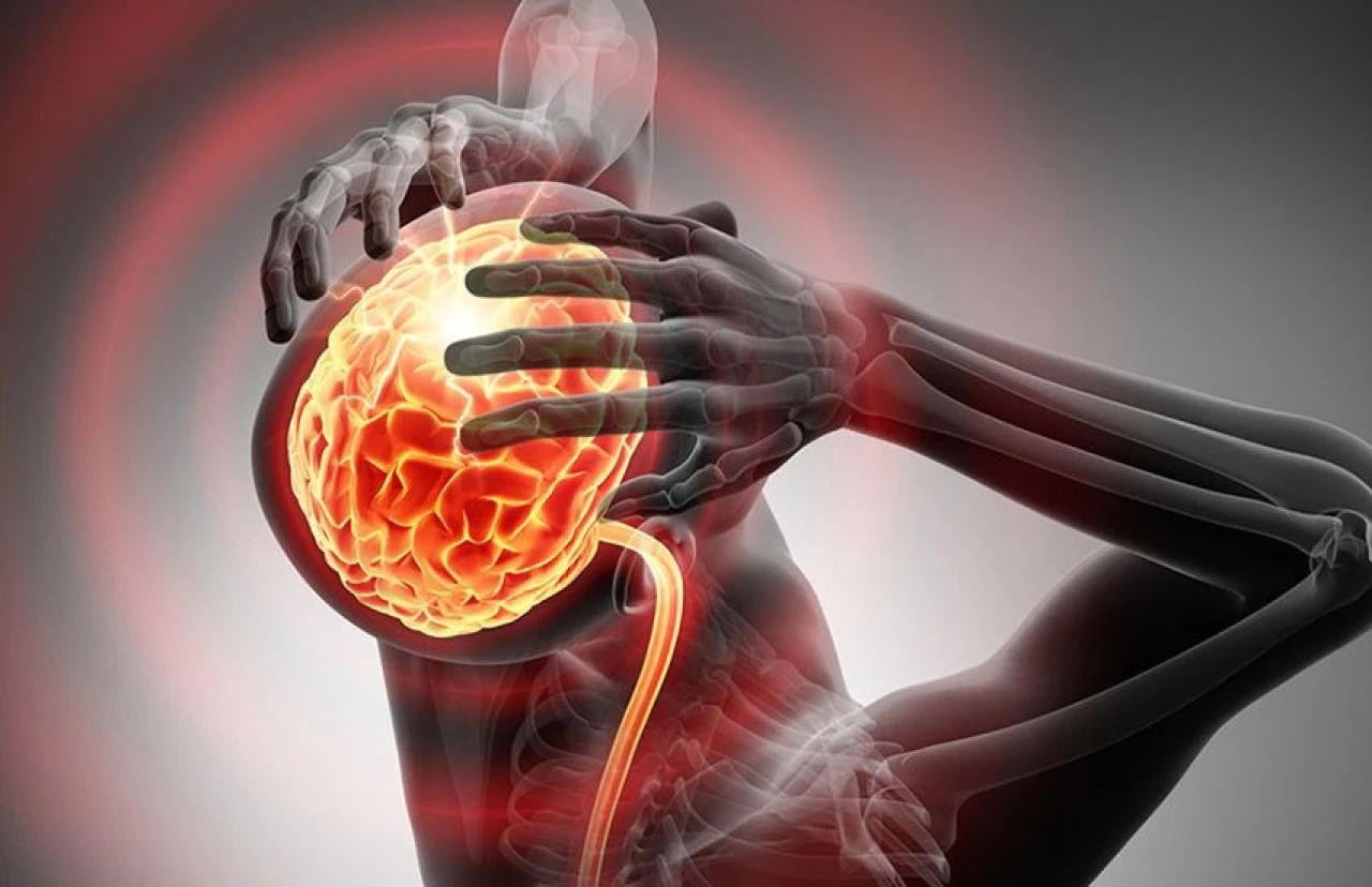 Baş ağrısı neden olur, nasıl geçer? Baş ağrısına ne iyi gelir? - 3. Resim