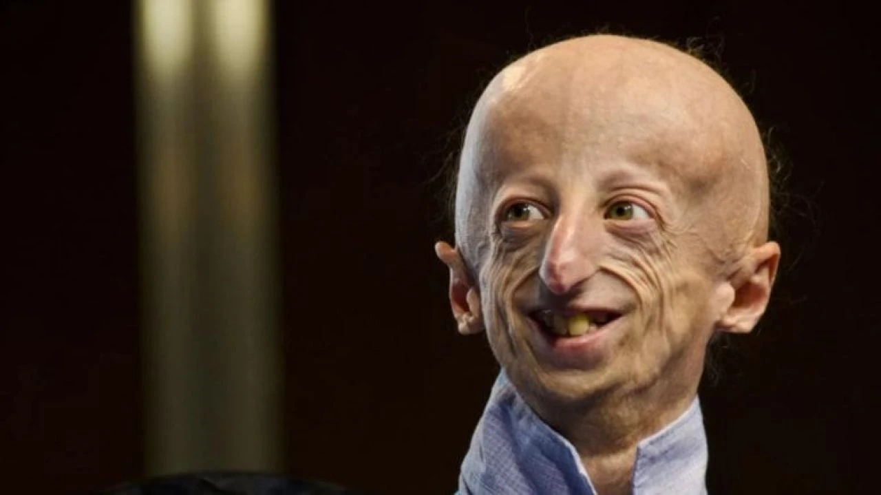 Benjamin Button hastası Sammy Basso hayatını kaybetti! Hızlı yaşlanma hastalığına rağmen en uzun yaşayan kişi - 1. Resim