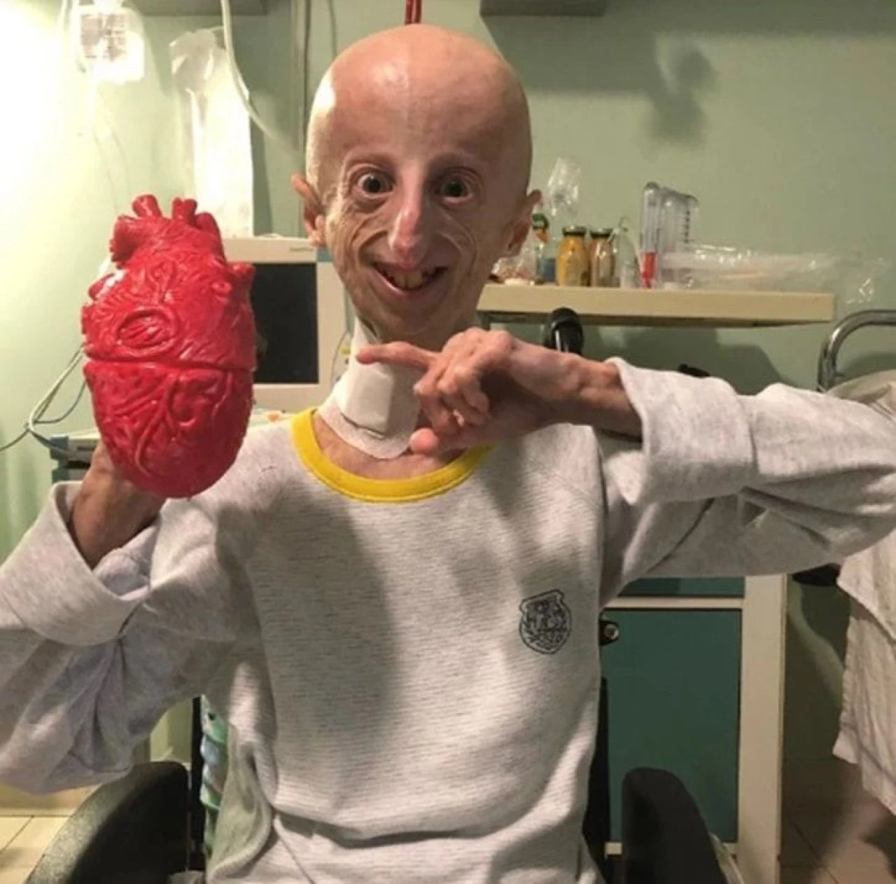 Benjamin Button hastası Sammy Basso hayatını kaybetti! Hızlı yaşlanma hastalığına rağmen en uzun yaşayan kişi - 4. Resim