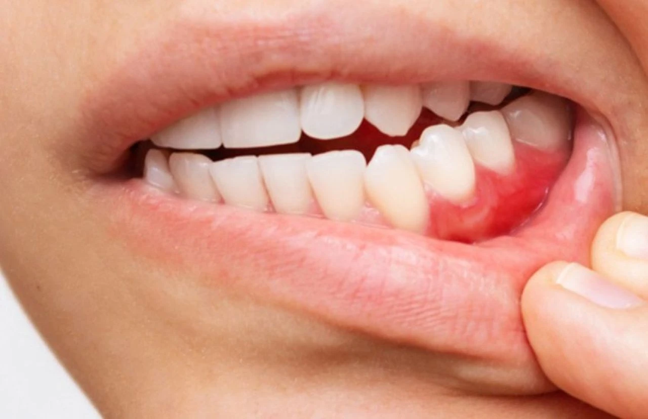 Diş ağrısı neden olur, nasıl geçer? Diş ağrısına ne iyi gelir?