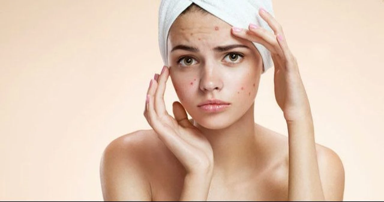 Sivilce izleri nasıl geçer? Yüzde sivilce izlerine ne iyi gelir?