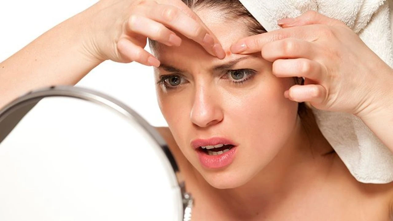 Sivilce izleri nasıl geçer? Yüzde sivilce izlerine ne iyi gelir?