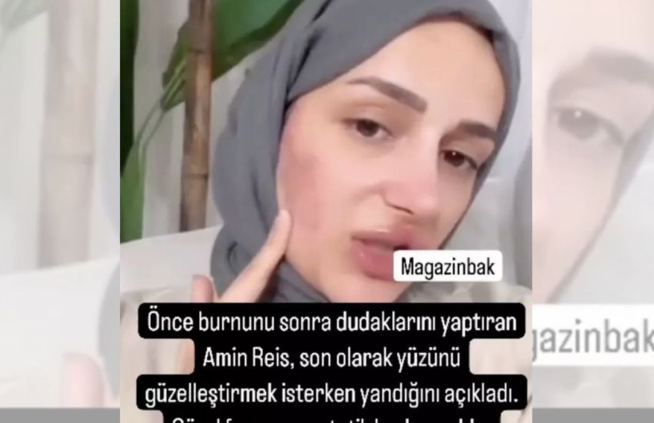 'Amin' videosuyla fenomen olan Gizem Yıldız'ın yüzü yandı! Son halini sosyal medyadan paylaştı - 1. Resim