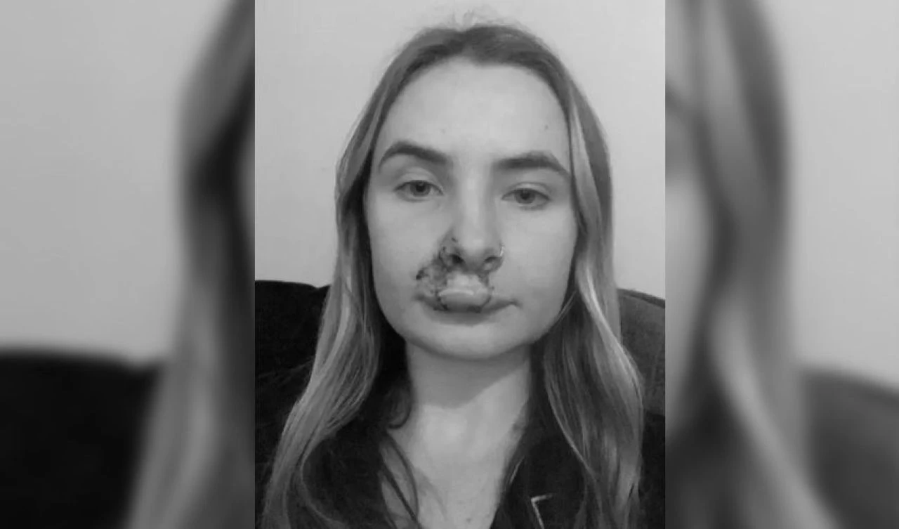 Önce laf attı sonra yüzünü ısırdı! Genç kıza 50 dikiş atıldı - 1. Resim