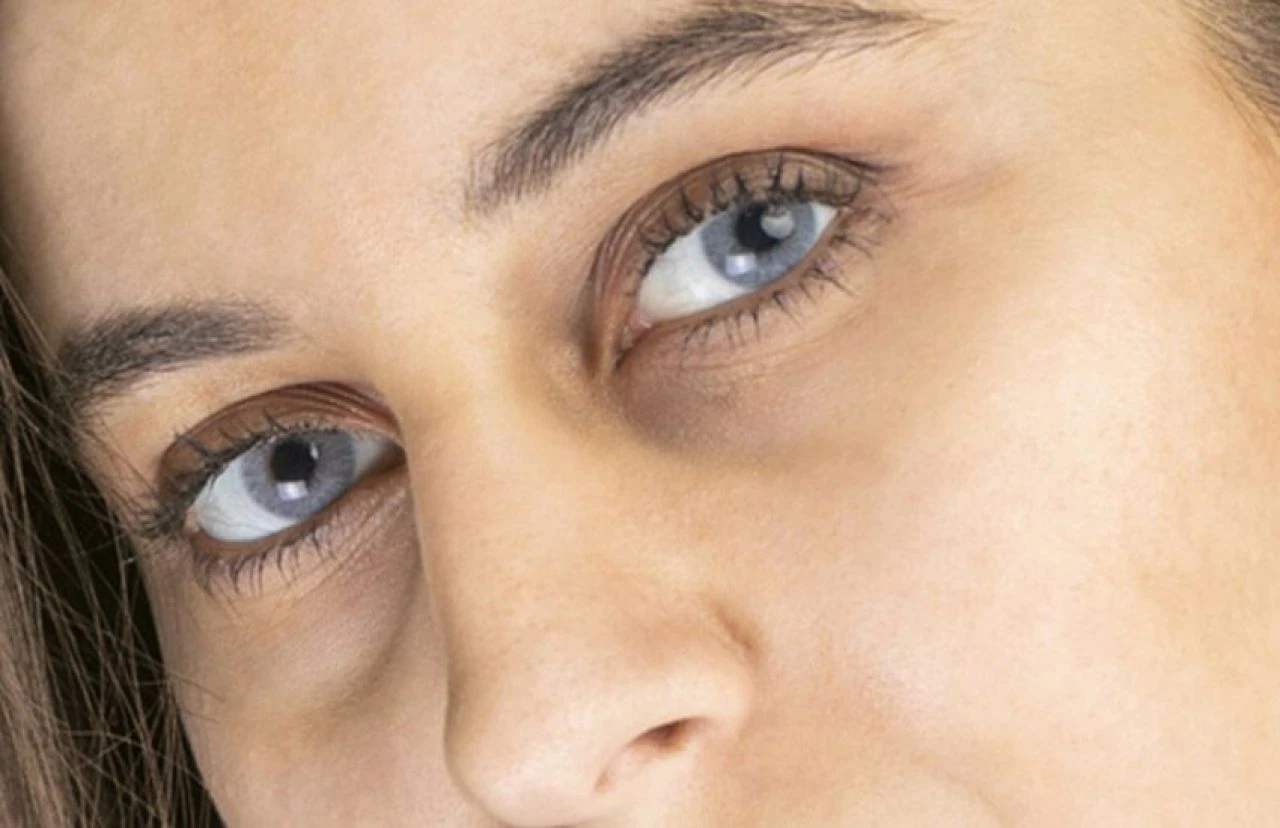 Göz altı morlukları için etkili doğal tedavi yöntemleri: Evde göz altı morlukları nasıl geçer? - 2. Resim